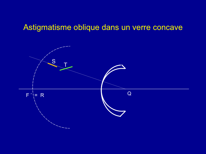 11CR-Astigmatisme35.png