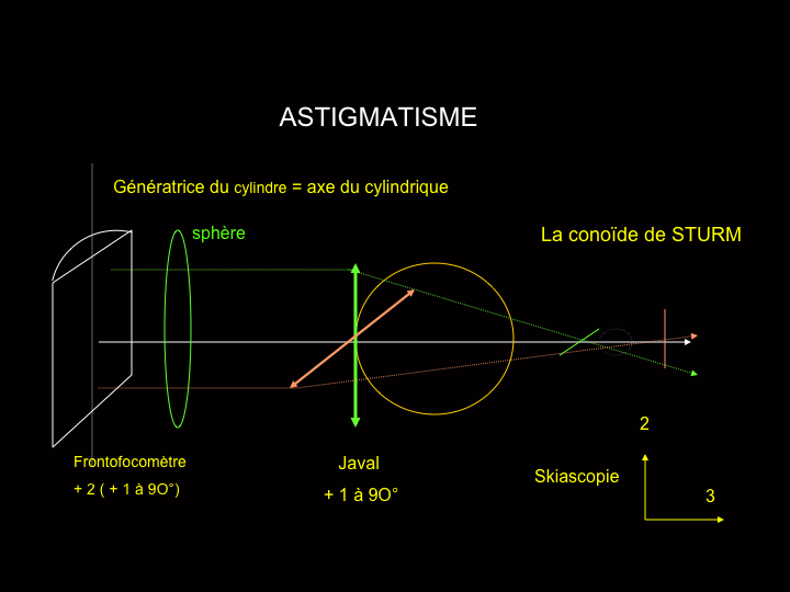 11CR-Astigmatisme44.png