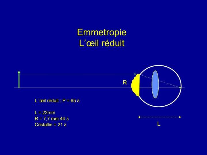 11CR-OptiqueAmetropies10.png