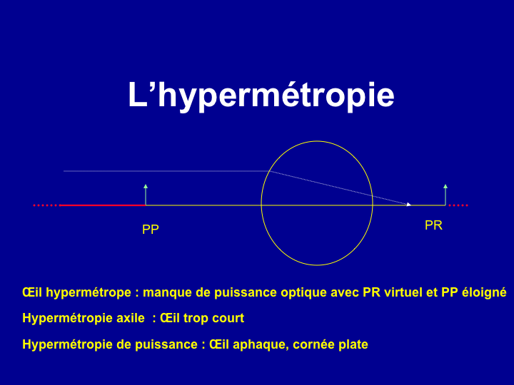 11CR-OptiqueAmetropies25.png