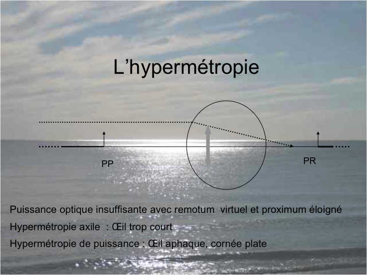 11CR-OptiqueAmetropies26.png