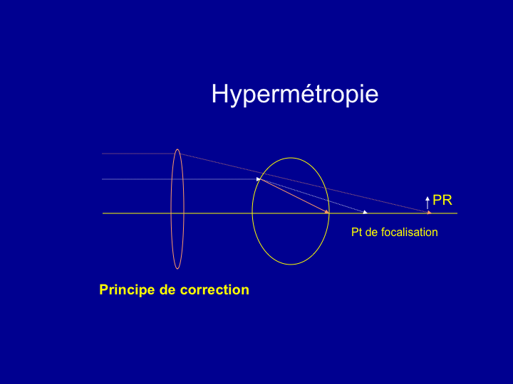 11CR-OptiqueAmetropies27.png