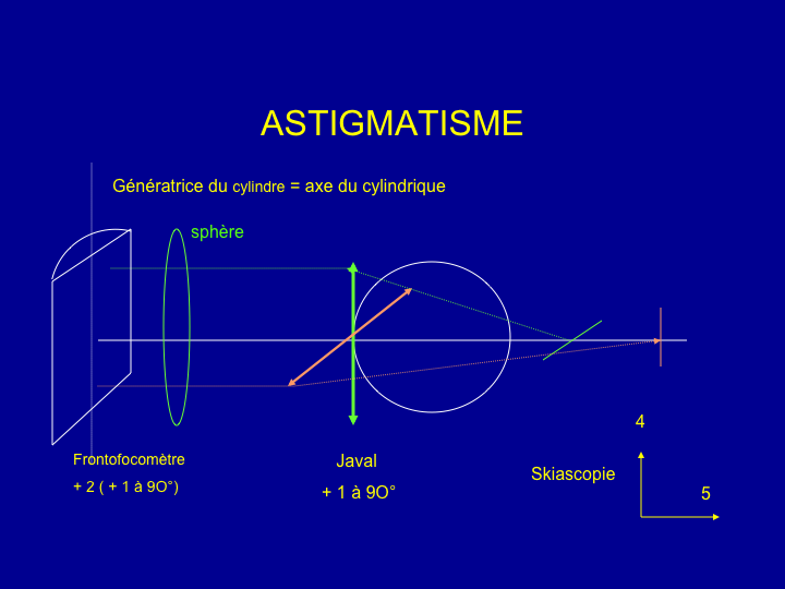 11CR-OptiqueAmetropies30.png