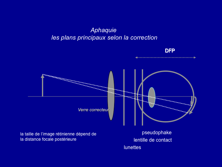 11CR-OptiqueAmetropies58.png